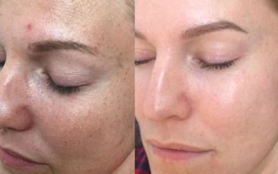 Hyperpigmentatie wat is dat en wat kun je er tegen doen?